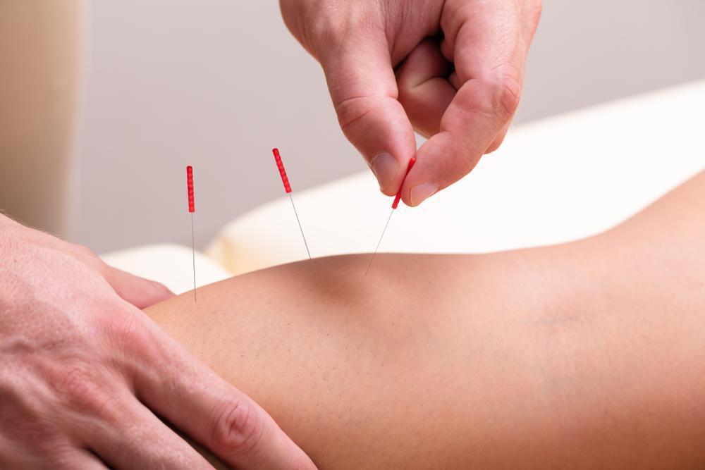 dry needling